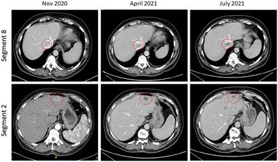 Case report: Successful treatment of a patient undergoing haemodialysis with multifocal hepatocellular carcinoma using atezolizumab and bevacizumab